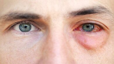 ماجرای شیوع کرونای چشمی در کشور 8 | نقش نیوز ماجرای شیوع کرونای چشمی در کشور